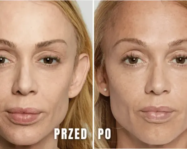 Przed i po zabiegu Sculptra. Zmarszczki wokół ust i oczu są mniej widoczne. Brak informacji o skutkach ubocznych.