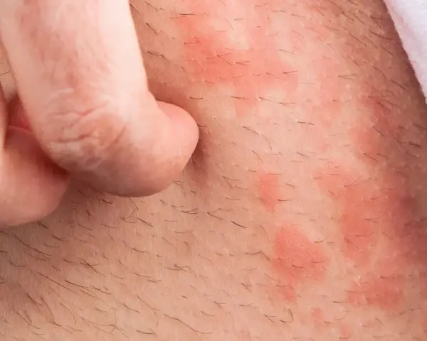 Haut mit roten Flecken und Haaren, die von einem Finger gekratzt werden. Backpulver gegen Juckreiz könnte Linderung verschaffen.