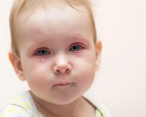 Bebé con ojos rojos e irritados, una lágrima cayendo, indicativo de conjuntivitis vírica.