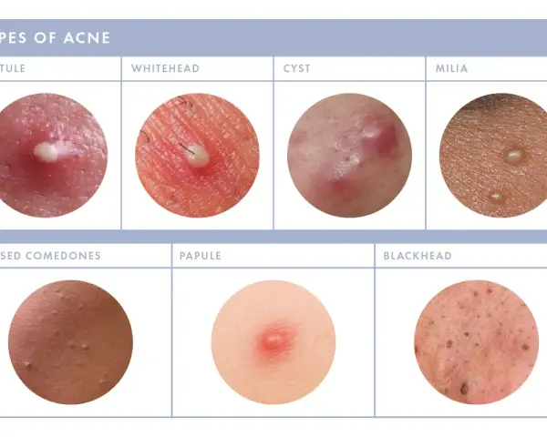Close-up images show various types of acne, including pustules, whiteheads, cysts, milia, closed comedones, papules, and blackheads. Some show small white bumps on the face.