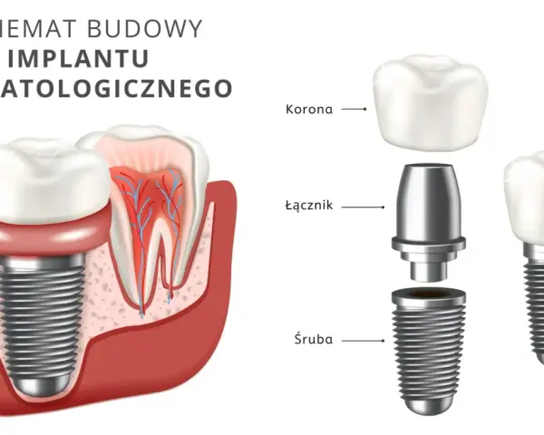 Schemat budowy implantu stomatologicznego: korona, łącznik i śruba.