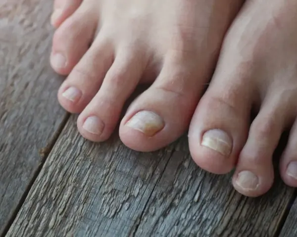 Dedos de los pies con uñas afectadas por tipos hongos en los pies, mostrando decoloración y engrosamiento.