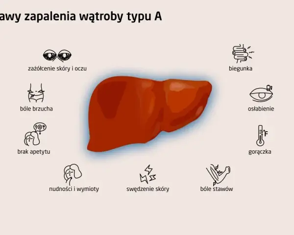 Objawy zapalenia wątroby typu A: zażółcenie skóry, bóle brzucha, brak apetytu, nudności, biegunka, osłabienie, gorączka, bóle stawów, swędzenie skóry.