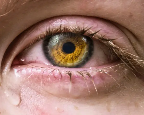 Occhio con iride dorata, palpebre arrossate e lacrime che scendono, sintomo di occhio secco grave.