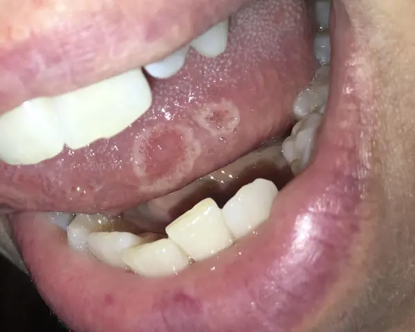 Lingua con afte dolorose. Le lesioni biancastre e rosse sono visibili sulla superficie della lingua, circondate da un alone infiammato.