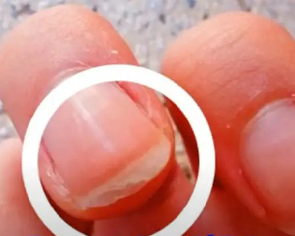 Gros plan sur un ongle qui se dédouble, montrant les couches séparées. Comprendre pourquoi les ongles se dédoublent peut aider à prévenir ce problème.
