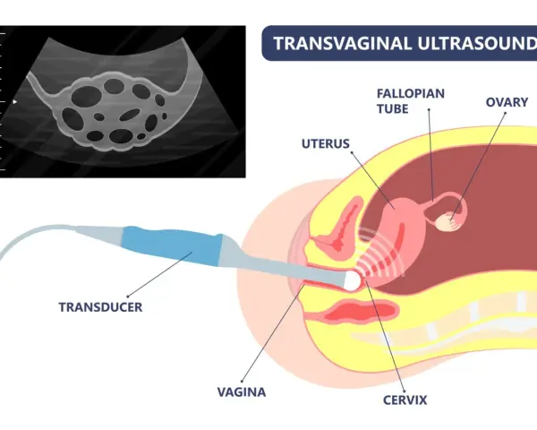 Transvaginaler Ultraschall zur Diagnose von Endometriose. Ein Ultraschallkopf wird in die Vagina eingeführt, um Gebärmutter, Eierstöcke und Eileiter abzubilden.