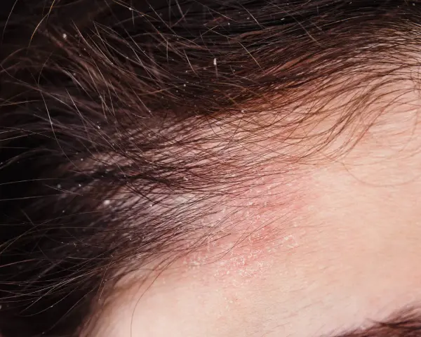 Nahaufnahme der Kopfhaut mit roten, schuppigen Stellen und feinen Haaren. Dies deutet auf Schuppenflechte am Kopfhautrand hin, die auch Haarausfall verursachen kann.