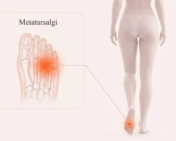 Illustration av en fot med markerad smärta i framfoten, som visar metatarsalgi. En figur visar smärtan i foten.
