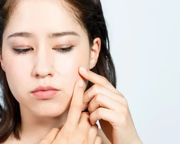 Czy pryszcze same znikają? Sprawdź, kiedy potrzebna jest pomoc dermatologa