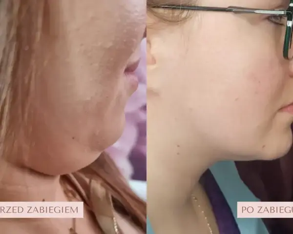 Przed i po zabiegu lipolizy podbródka. Widoczna redukcja tkanki tłuszczowej, wyraźniejsza linia żuchwy.