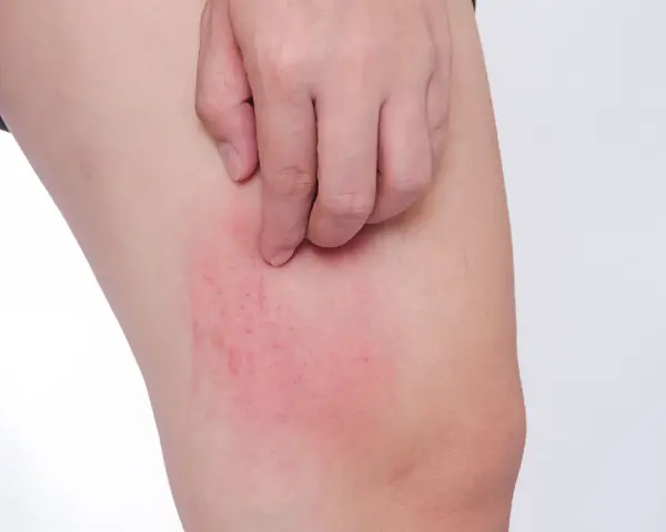 Rote, juckende Stelle am Bein, ein mögliches Symptom von Diabetes haut.