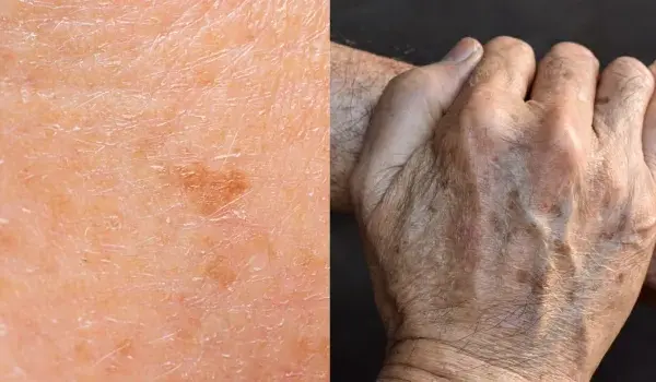 Nahaufnahme von Haut mit Pigmentflecken, Falten und Altersflecken. Retinol gegen Pigmentflecken kann helfen, das Hautbild zu verbessern.