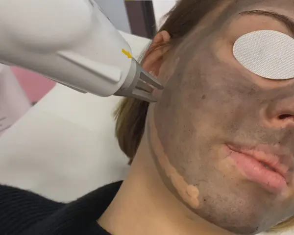 Zabieg laserowy na twarz z maską węglową. Skóra przygotowana do peelingu węglowego.
