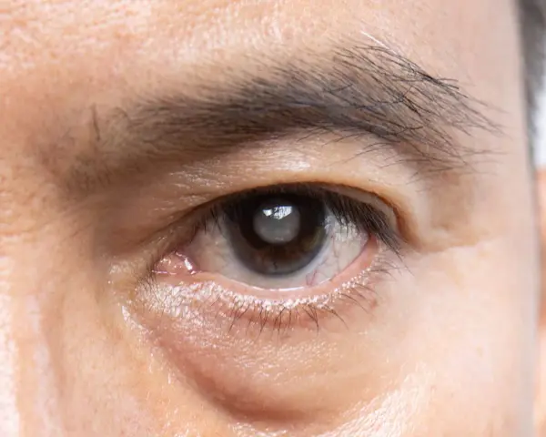 Occhio con opacità del cristallino (pseudofachia) e segni di possibile distacco retina.