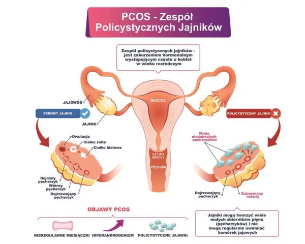 Ilustracja przedstawia budowę jajników, porównując zdrowy jajnik z jajnikiem w zespole policystycznych jajników (PCOS). W tym drugim widoczne są liczne niedojrzałe pęcherzyki.