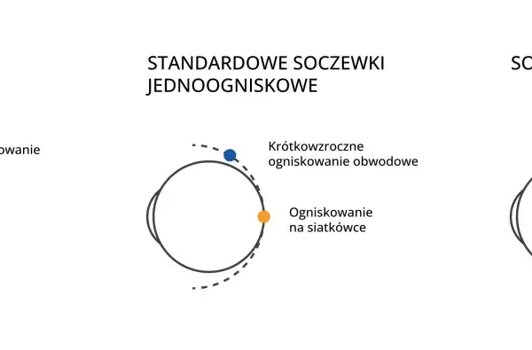 Schemat oka z ogniskowaniem światła przy krótkowzroczności i korekcji soczewkami.