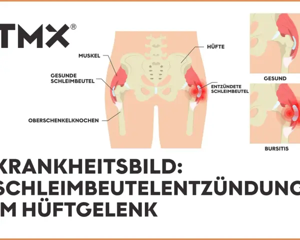 Illustration zeigt das Hüftgelenk mit gesunden und entzündeten Schleimbeuteln. Bursitis trochanterica als Krankheitsbild.
