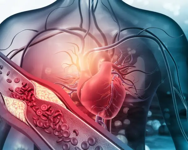 Zatkana tętnica z cholesterolem i czerwonymi krwinkami, obok czerwonego serca. Zrozumienie, po której stronie serce, jest kluczowe dla zdrowia.