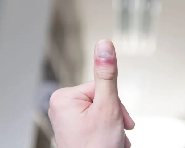 Zastrzał palca z zaczerwienieniem i obrzękiem wokół paznokcia.