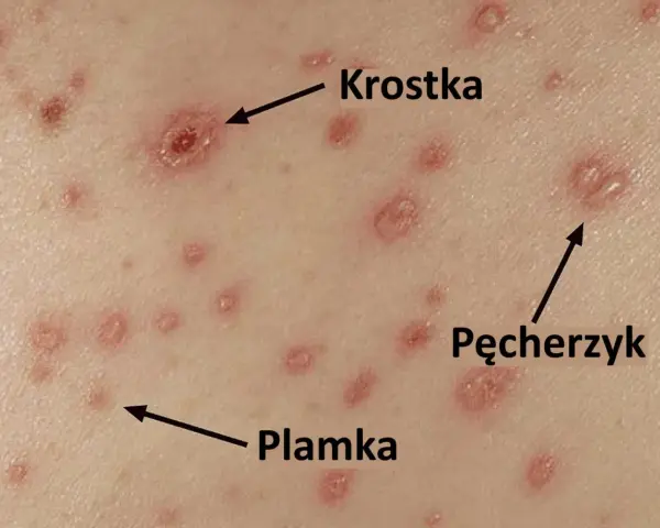 Skóra z licznymi zmianami: plamkami, krostkami i pęcherzykami, typowymi objawami ospy wietrznej.