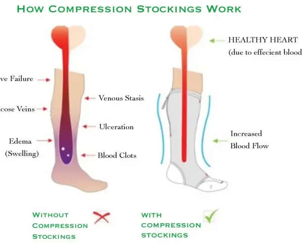 Diagram shows how compression stockings help with inflammation by improving blood flow, preventing issues like edema and varicose veins.