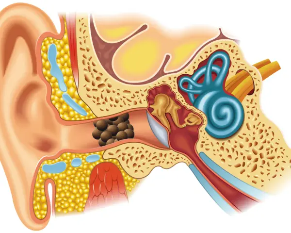 Coupe de l'oreille montrant un bouchon de cérumen dans le conduit auditif, potentiellement cause de vertiges.