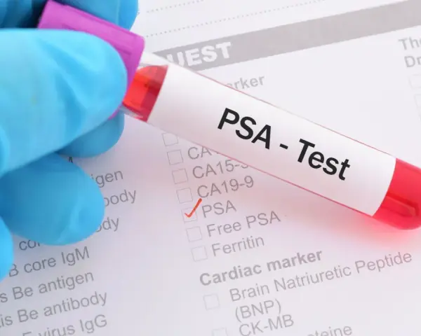 Rękawiczka w niebieskiej rękawiczce trzyma probówkę z krwią do testu PSA. Na formularzu zaznaczono PSA.