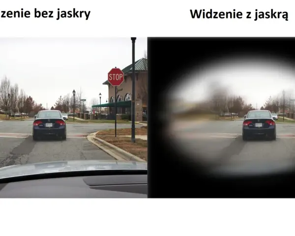 Porównanie widzenia: po lewej - normalne, po prawej - z jaskrą (widoczne ubytki w polu widzenia).