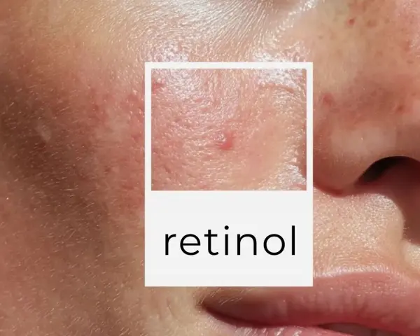 Zbliżenie na skórę z widocznymi niedoskonałościami, zaczerwienieniami i wypryskami. W ramce tekst "retinol", sugerujący wysyp po retinolu.