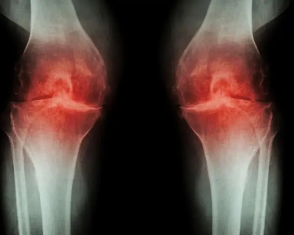 RTG kolan z zaznaczoną osteofitami i zwężeniem szpary stawowej, sugerujące chorobę zwyrodnieniową. Może być wskazana osteotomia podkolanowa.