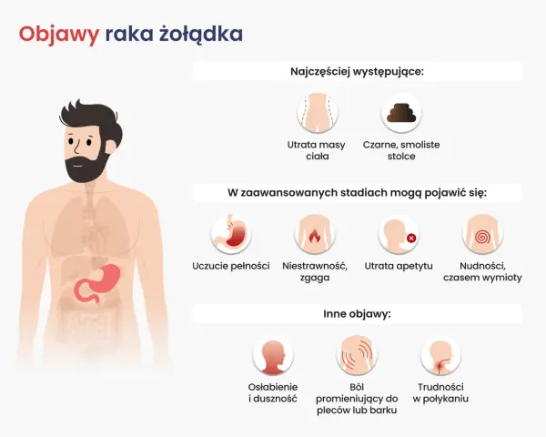 Objawy raka żołądka: utrata masy ciała, czarne stolce, niestrawność, nudności, ból pleców, trudności w połykaniu.