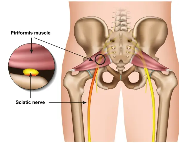 Illustration zeigt das Piriformis-Syndrom: Der Piriformis-Muskel drückt auf den Ischiasnerv.