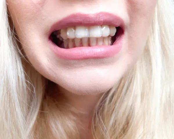 Zbliżenie na usta kobiety z widocznymi przezroczystymi nakładkami Invisalign na zębach.