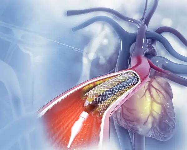Stent w tętnicy serca podczas zabiegu angioplastyki.