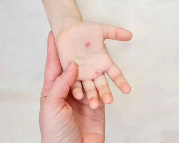 Ospa u dziecka: Bezpieczne leczenie, ulga od świądu i gorączki