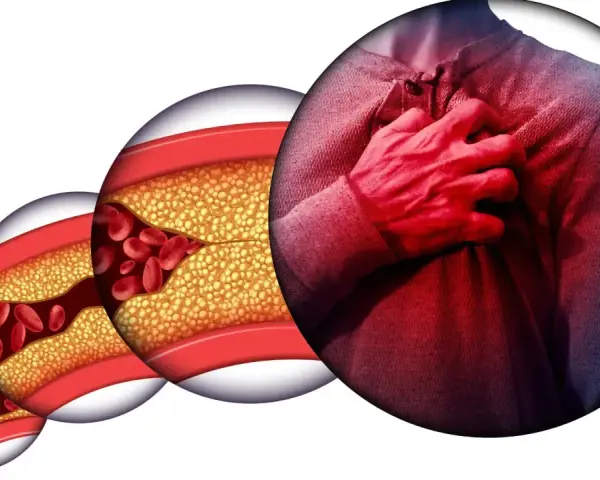 Postępująca choroba wieńcowa: zwężone naczynia krwionośne z cholesterolem i czerwonymi krwinkami, obok mężczyzna trzymający się za serce.