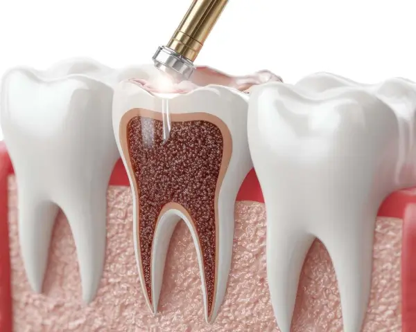 Zabieg stomatologiczny: narzędzie dentystyczne usuwa tkankę z zęba, lecząc zatrucie zęba.