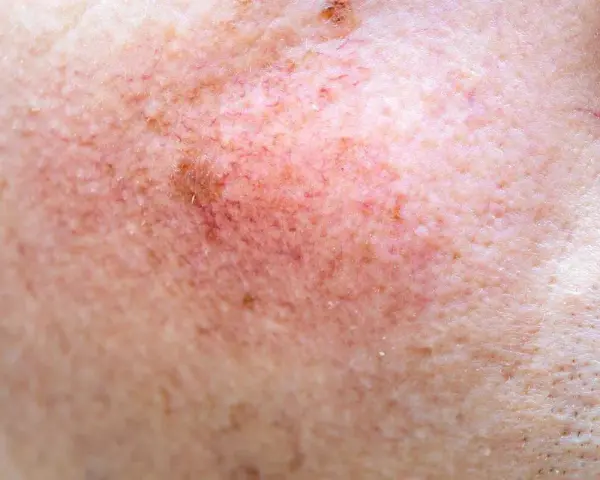 Skóra z widocznymi naczynkami i przebarwieniami, czekająca na retinol efekty.