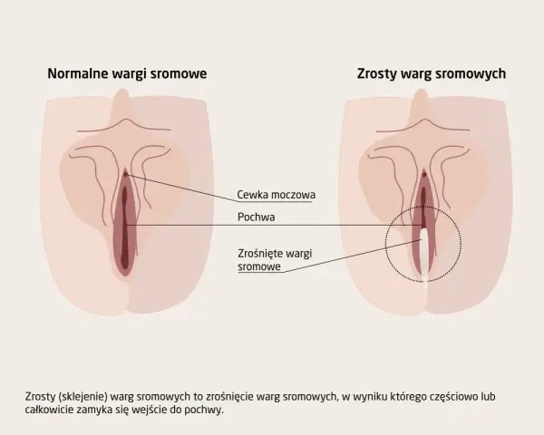 Ilustracja porównuje normalne wargi sromowe z zrośniętymi, które mogą wymagać operacji plastycznej pochwy.