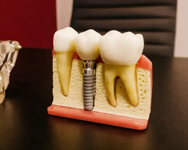 Model szczęki z zębami i mikroimplantem ortodontycznym. Implant zastępuje korzeń zęba, zapewniając stabilne podparcie dla korony.