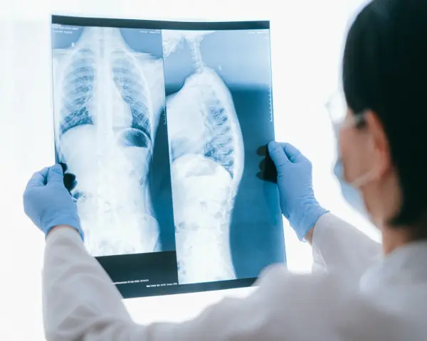 Lekarz w niebieskich rękawiczkach analizuje RTG klatki piersiowej i kręgosłupa, szukając oznak osteoporozy.