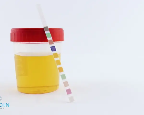 Pojemnik z żółtym moczem i paskiem testowym do analizy. Wyniki mogą wskazywać na obecność bilirubiny w moczu.