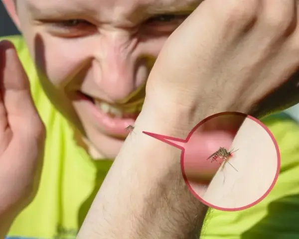 Bąble jak po ugryzieniu komara alergia – objawy i skuteczne leczenie