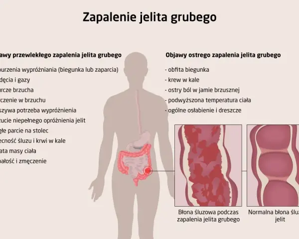 Zapalenie jelita grubego: objawy przewlekłe (biegunka, zaparcia, wzdęcia, bóle brzucha) i ostre (obfita biegunka, krew w kale, gorączka).