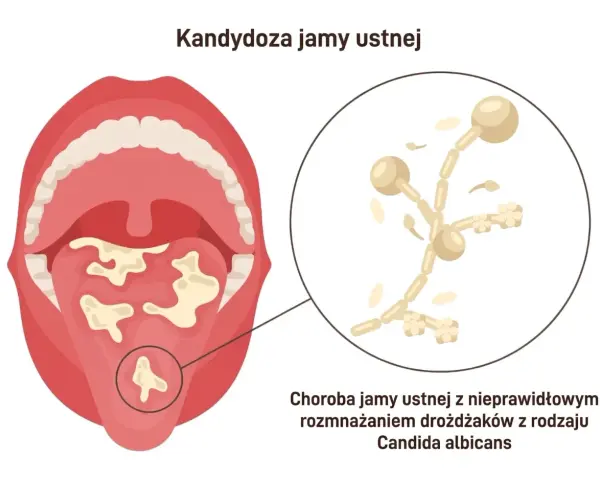 Kandydoza jamy ustnej: białe naloty na języku i podniebieniu, powiększone drożdżaki Candida. Objawy mogą być niepokojące.