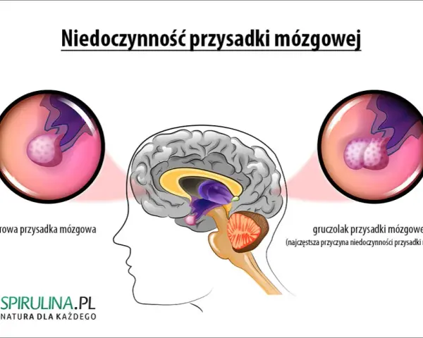 Mgła mózgowa, lęk, depresja? To może być gruczolak przysadki