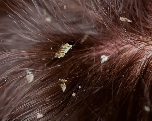 Primer plano de cabello castaño con descamación en el cuero cabelludo, mostrando escamas blancas y amarillentas entre los mechones.