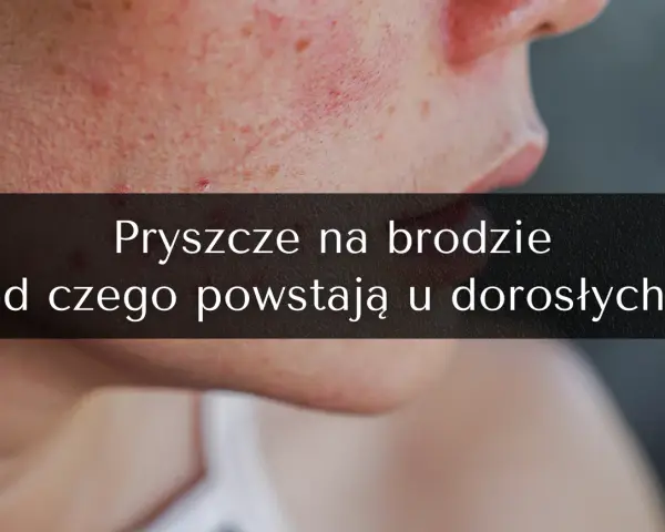 Pryszcze na brodzie: Jak się ich pozbyć? Kompletny poradnik ekspertki