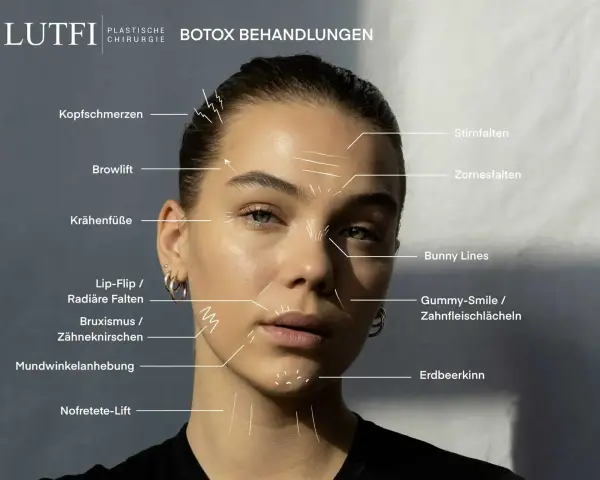 Gesicht einer Frau mit Markierungen für Botox-Behandlungen, die auch Bunny Lines zeigt.